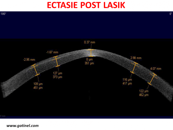 OCT en coupe sagittale d’une cornée présentant une ectasie post LASIK. Noter la déformation centrale avec cambrure accentuée irrégulière. L’épaisseur du capot est estimée à 120 microns en moyenne. Au centre, l’épaisseur du capot semble réduite, et l’épaisseur totale de la cornée est estimée proche de 350 microns. 