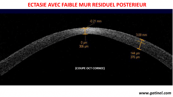 ectasie mur résiduel postérieur insuffisant