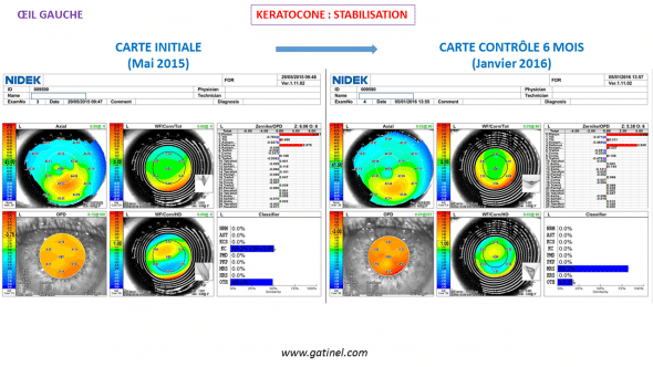 Absence de progression du kératocône de l'oeil droit : comparaison de cartes topographiques (OPDscan III)