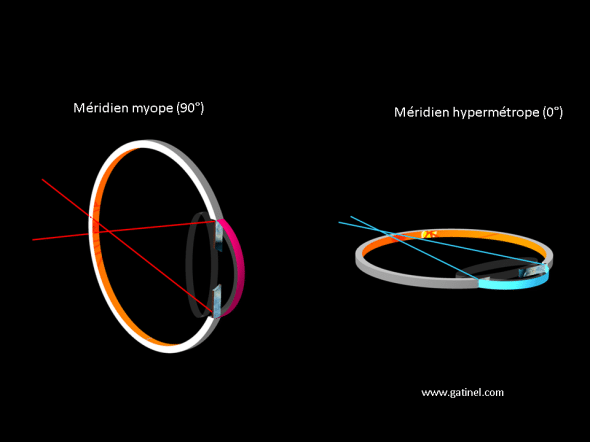 variations de vergence entre méridien vertical et horizontal œil astigmate