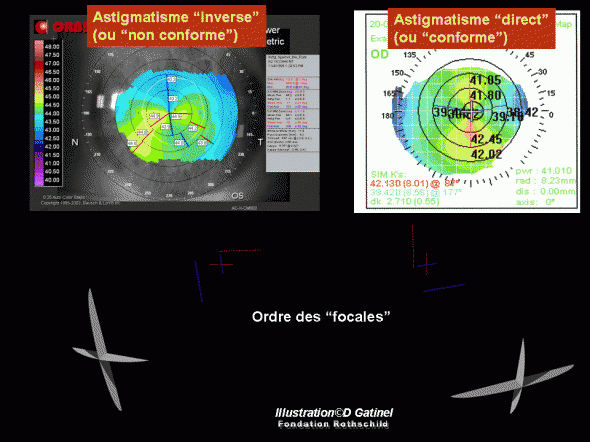 Astigmatisme direct et indirect