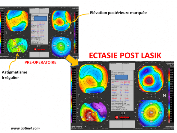 Ectasie apparue deux ans après la réalisation d’un LASIK chez une patiente de 36 ans, pour une myopie d’environ 6 D. En préopératoire, on note un astigmatisme irrégulier de l’œil droit, avec élévation marquée de la face postérieure. Il existait un terrain atopique avec notion de frottements oculaires digitaux répétés. La carte post opératoire révèle un aspect d’amincissement central marqué, avec déformation asymétrique de la face antérieure, et élévation postérieure accentuée 