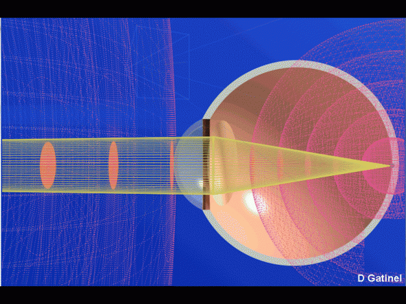front d'onde d'oeil gp
