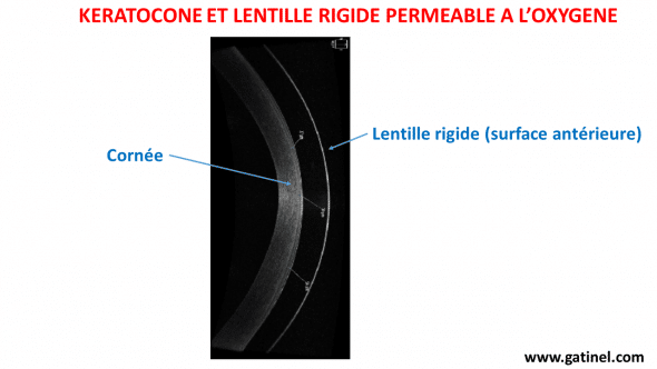 lentille rigide et kératocône en OCT haute résolution Zeiss Cirrus