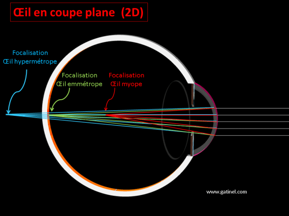 représentation des rayons dans un œil myope hypermétrope ou astigmate en deux dimensions