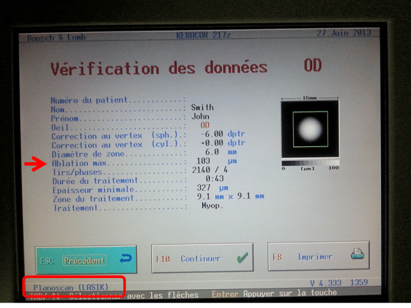 Simluation d'une correction de 6 Dioptries de myopie avec le mode Planoscan: l'ablation maximale centrale est de 103 microns
