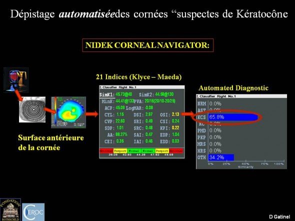 dépistage du kératocône frustre indices site D Gatinel