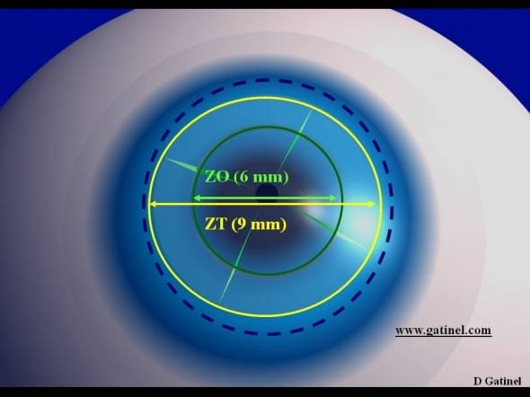 Correction de l hypermétropie zone optique zone transition