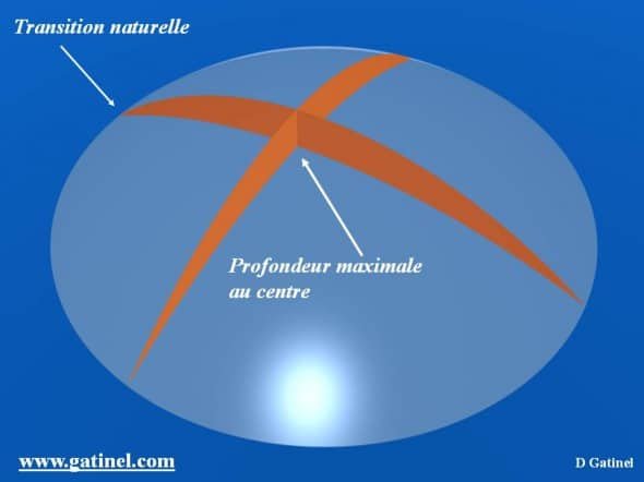 Profil d'ablation myopie correction myopie laser