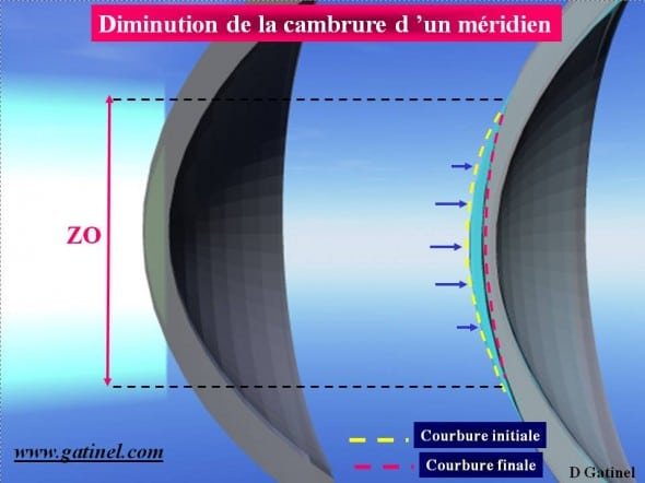 profil d'ablation myopie opération
