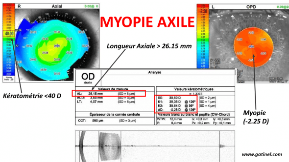 Schéma explicatif de la myopie axile et de l'allongement oculaire