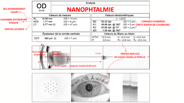 Biométrie œil nanophtalme