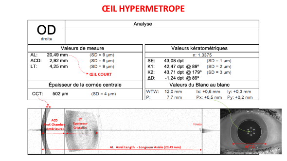 Biométrie œil hypermétrope