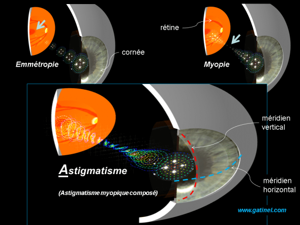 Comparaison entre astigmatisme, emmétropie et myopie