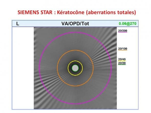Keratocone siemens star aberrations totales