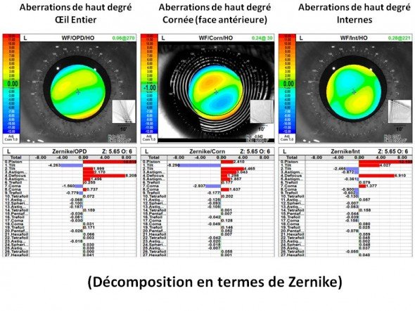 keratocone HOA Zernike