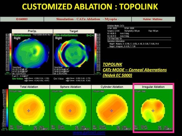 Profil d'ablation guidé par le front d'onde cornéen, à visée cornéoplastique