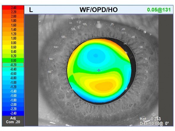aberration coma décentrement LASIK