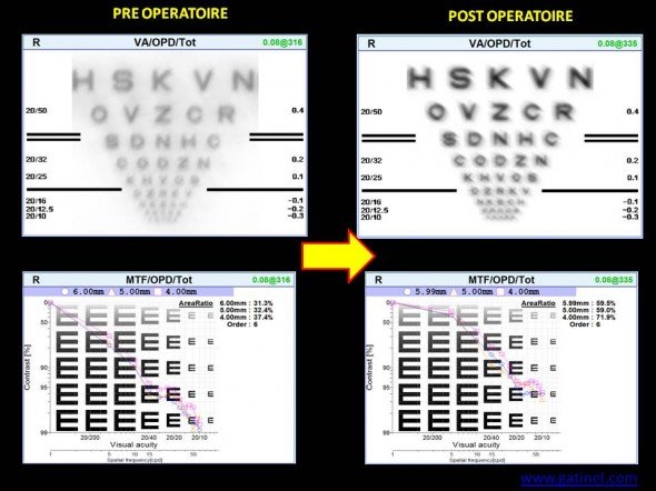 acuité visuelle et MTF convolution apres cornéo plastie