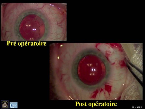 chirurgie recentrement implant