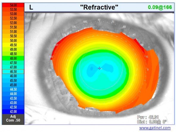 LASIK décentrement carte réfractive