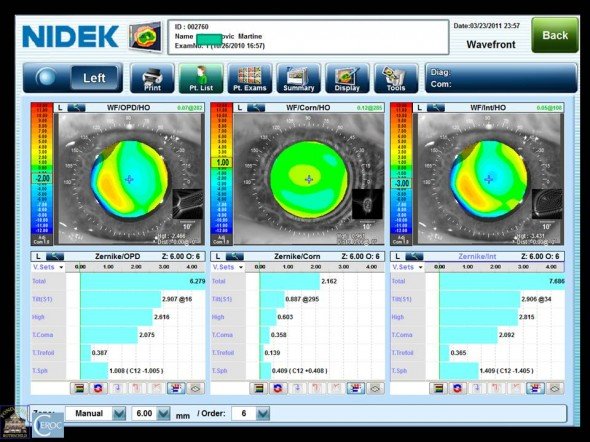 front d'onde aberration implant décentré
