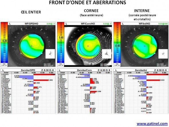 aberrrations HOA totale cornéennes internes