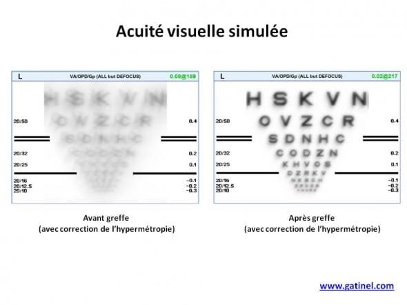 acuite visuelle convolution