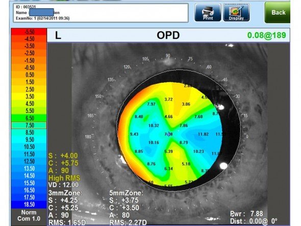 carte OPD réfraction dans la pupille greffe cornée