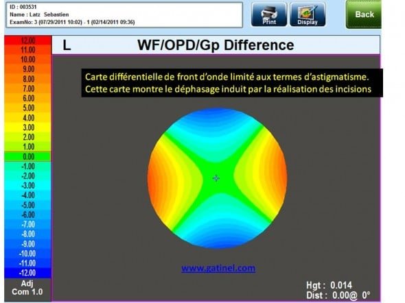 carte différentielle degré 2 front d'onde astigmatisme