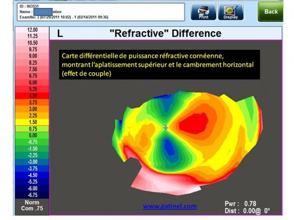 carte différentielle topographie mode réfractif