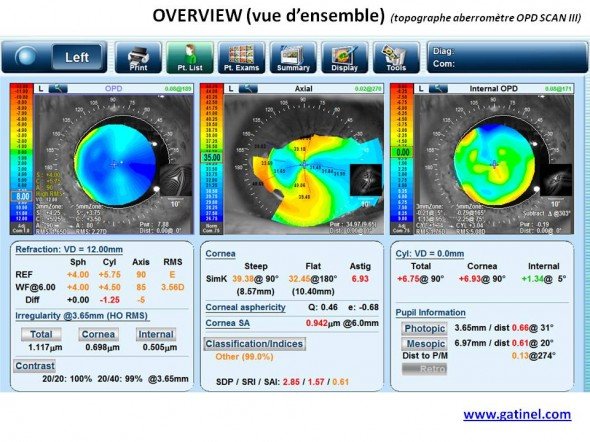 Mode overview, carte OPD post kératoplastie transfixiante greffe