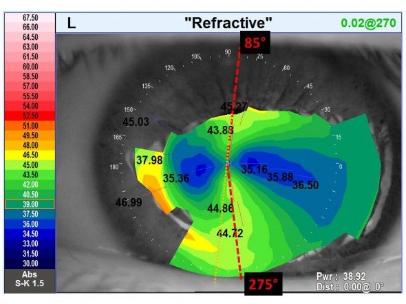 carte refractive topographie cornéenne