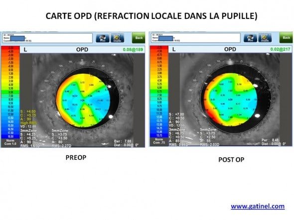 comparaison carte OPD pre post op