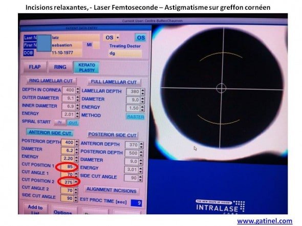 incisions relaxantes laser femtoseconde greffe astigmatisme