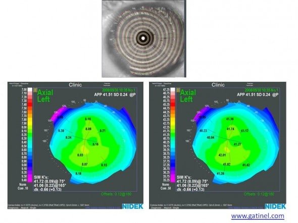 Cartes topographiques cornéennes de courbure - mode axial - Placido