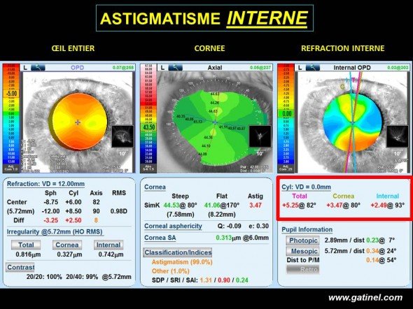 astigmatisme cornéen et interne conjgués