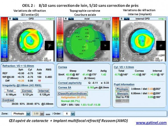 carte Nidek OPD implant multifocal refractif