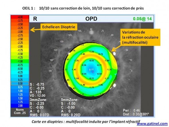 carte Nidek OPD implant multifocal