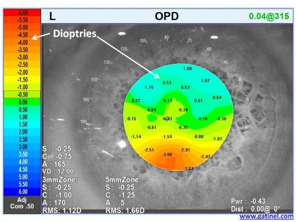 OPD implant torique astigmatisme irrégulier
