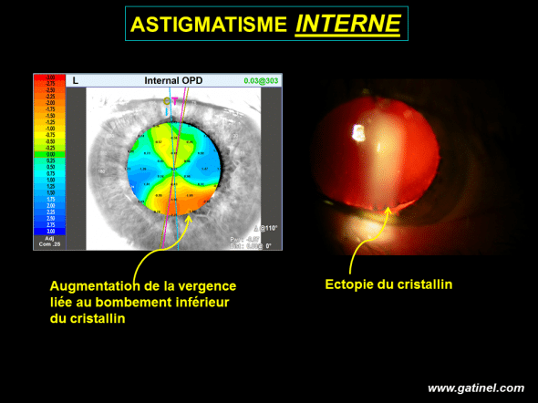 ectopie du cristallin avec augmentation de la vergence inférieure relachement zonulaire