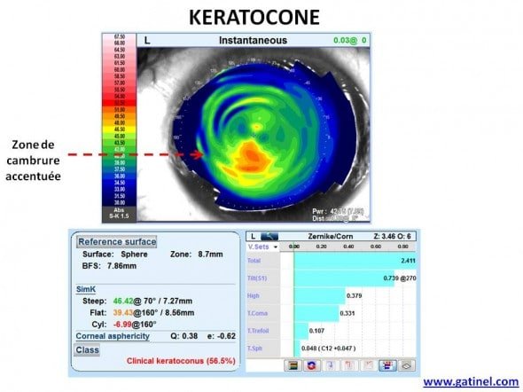 keratocone topographie OPD SCAN III Nidek
