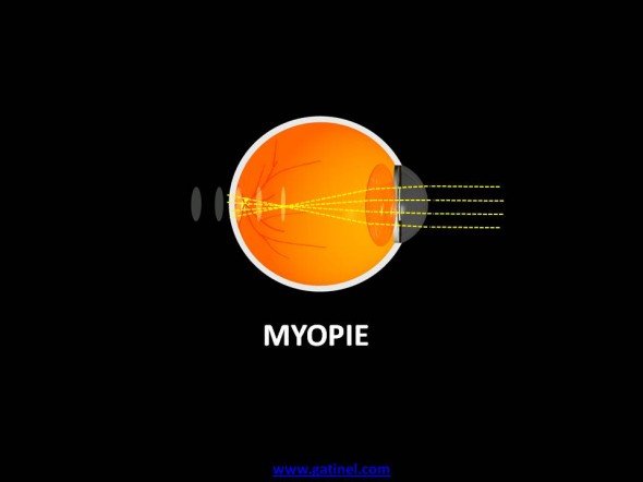 myopie 