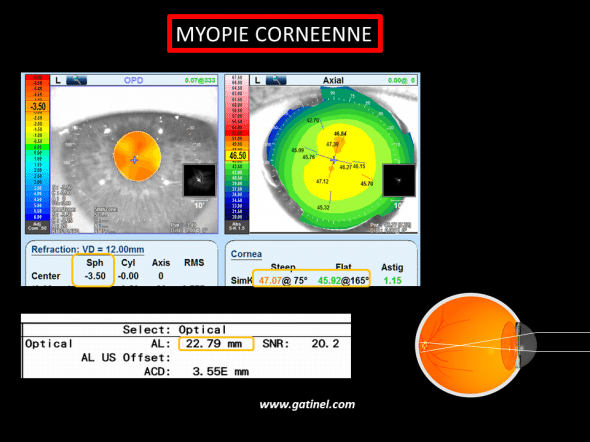 myopie par cambrure cornéenne accentuée