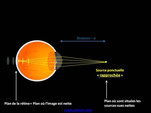 myopie  et image d'une source rapprochée