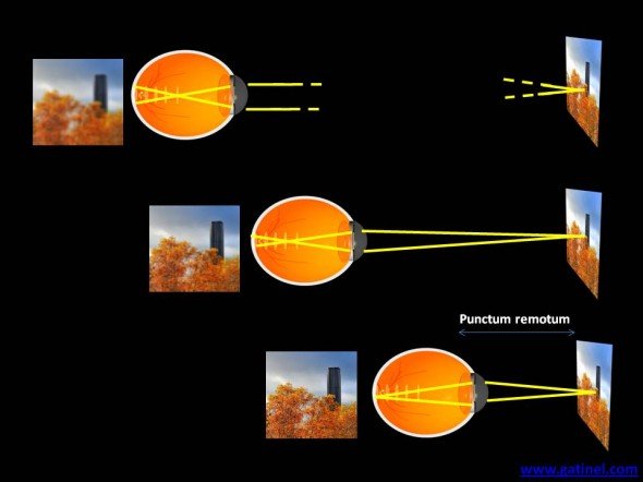 myopie flou et distance d'observation 
