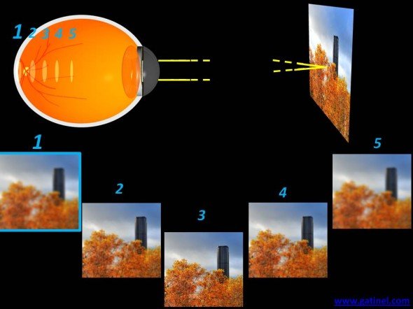 myopie oeil myope plan de l'image