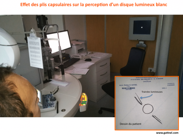 L'encadré correspond au dessin à main levée effectué par le patient au cours de l'observation d'un disque lumineux avec l'oeil opéré de cataracte. La nuit, ce patient perçoit des zébrures lumineuses, des traits autours des phares de voiture, réverbères, etc.