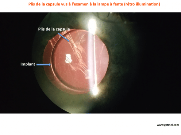 plis de capsule lampe à fente