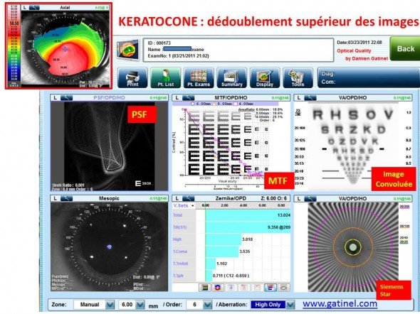 images fantomes & keratocone aberrométrie